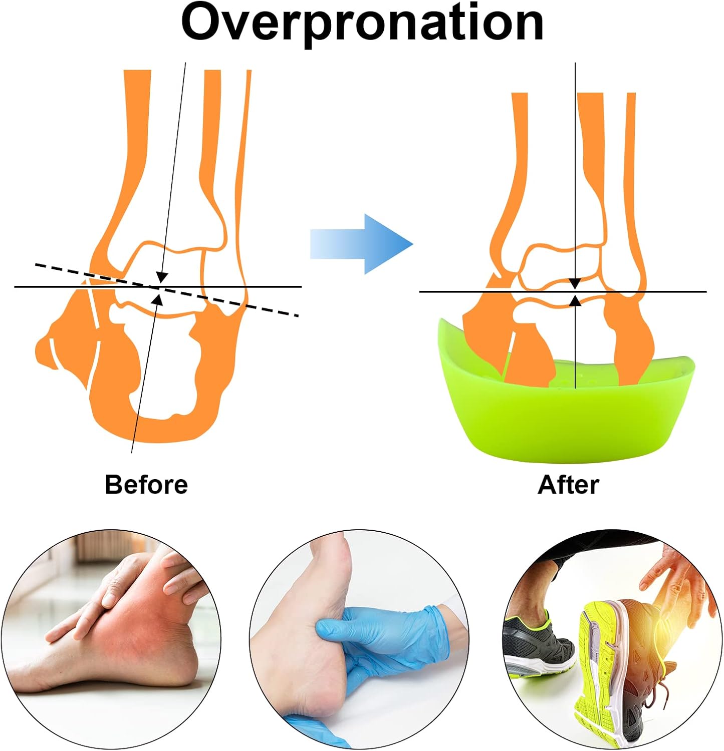 Almohadilla metatarsiana original de arco alto 34 para aliviar la pronación del pie, espalda, cadera, pierna y rodilla, espolones para el dolor para