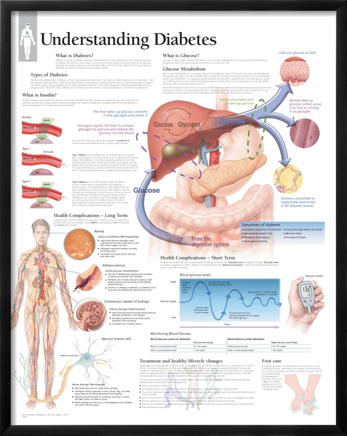 AllPosters Póster de pared para entender la diabetes, gráfico educativo sobre marco negro, 22 x 28 pulgadas