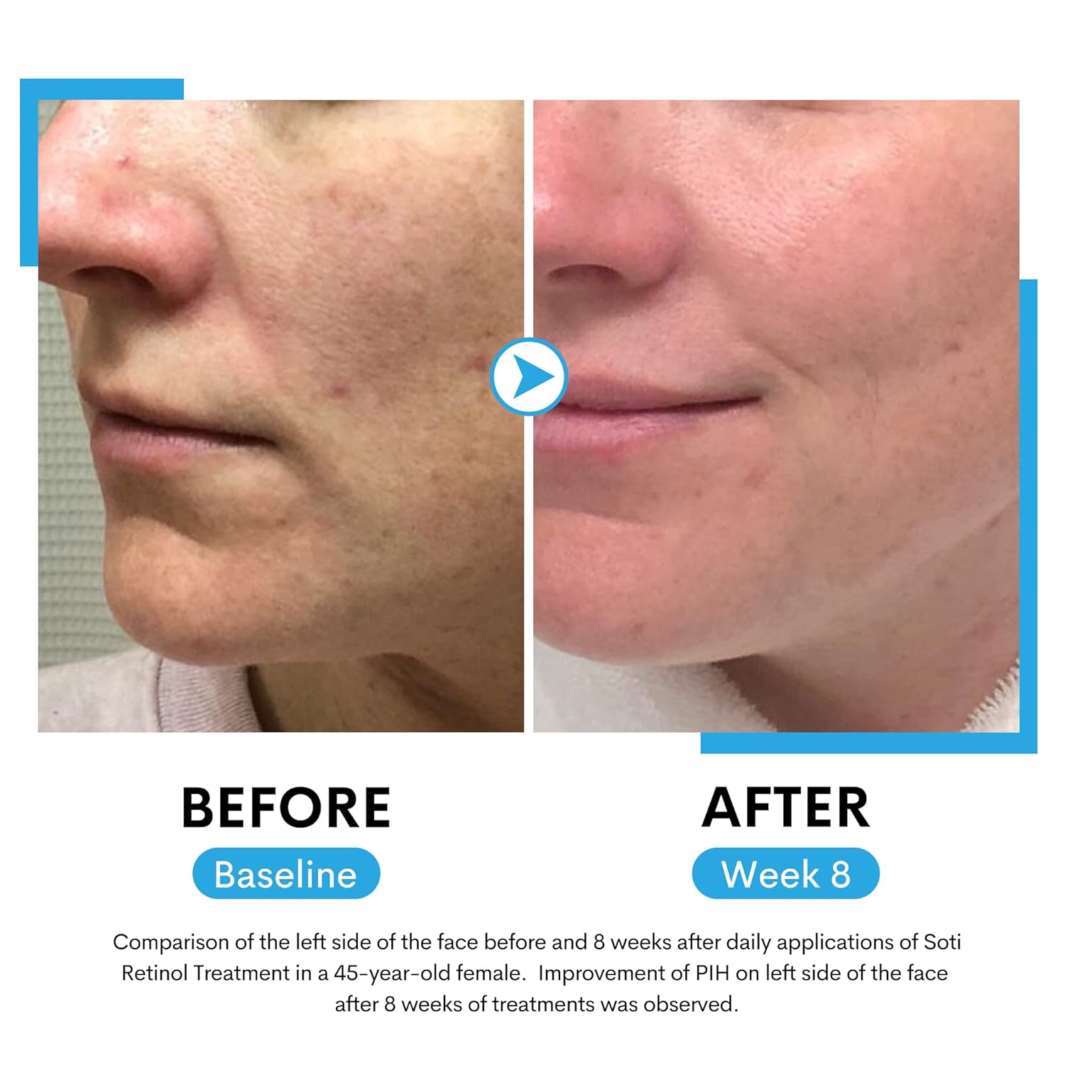 Suero de retinol para cara al 2.5% con niacinamida, ácido hialurónico y vitamina E. Suero facial antienvejecimiento para líneas, arrugas, manchas de