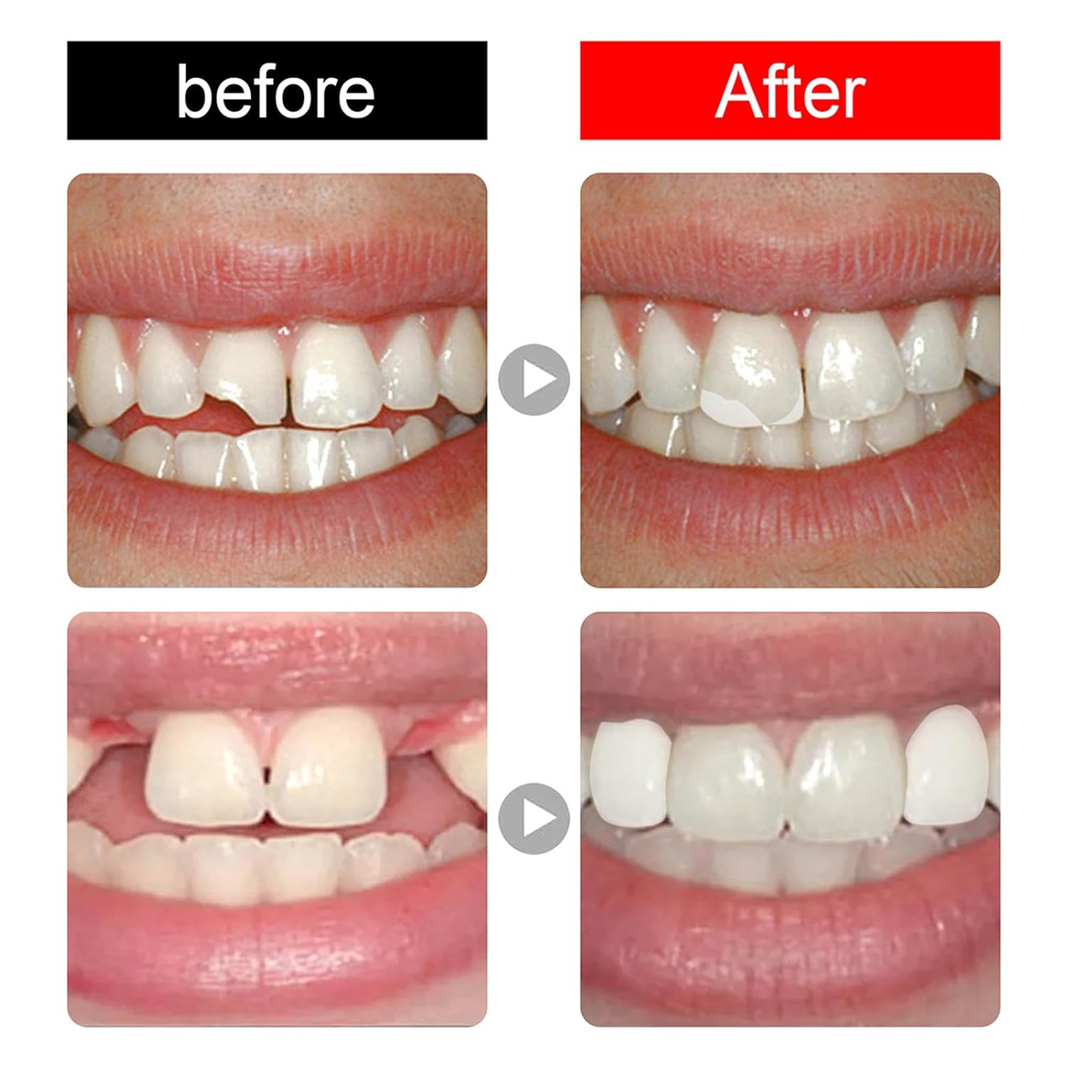Carillas de corona de dientes temporales dentales, dientes delanteros y posteriores molares con reparación de dientes, relleno térmico para dientes