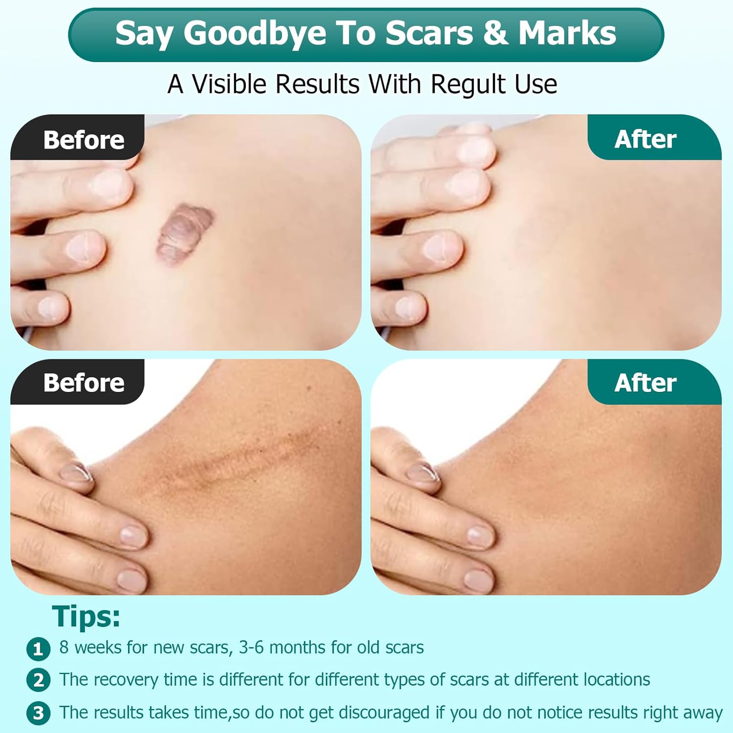 Gel de cicatrices, crema para cicatrices, gel avanzado para cicatrices quirúrgicas, cara, cuerpo, pierna, quemaduras, aceno, cesárea, estrías,