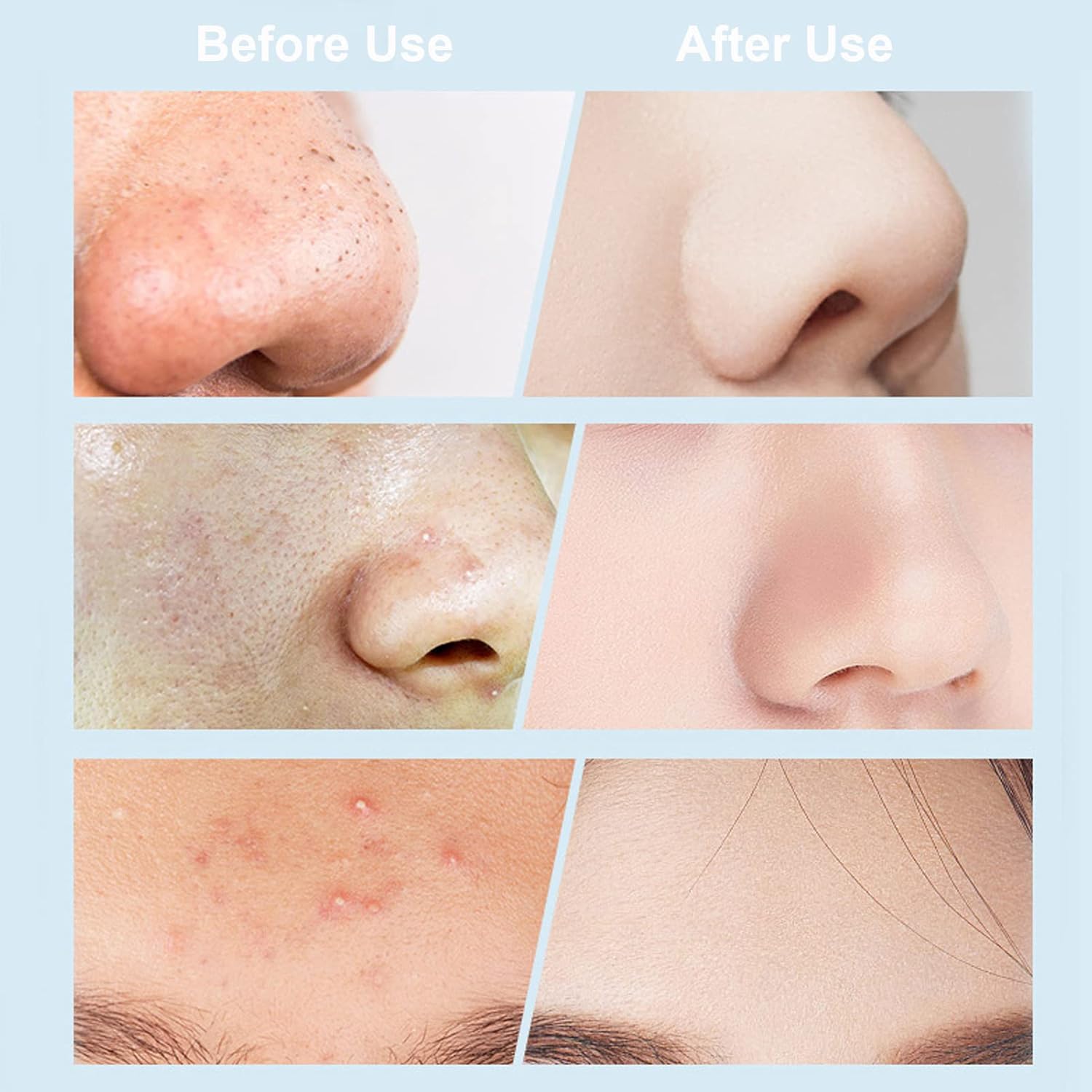 Aspiradora eliminadora de puntos negros, limpiador eléctrico de poros facial 2021, herramienta extractor de acné recargable por USB, kit de