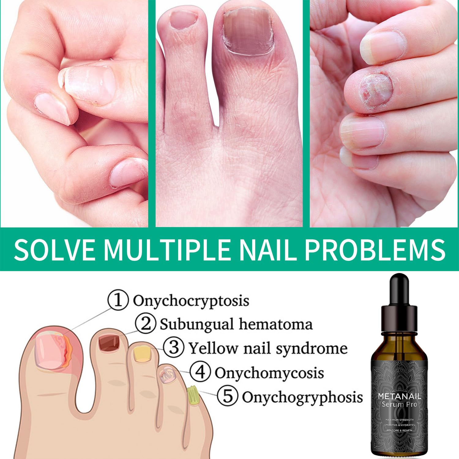 Tratamiento de uñas de metanail, tratamiento de crecimiento de uñas para tratamiento de uñas de los pies, extra fuerte para reparar uñas dañadas y