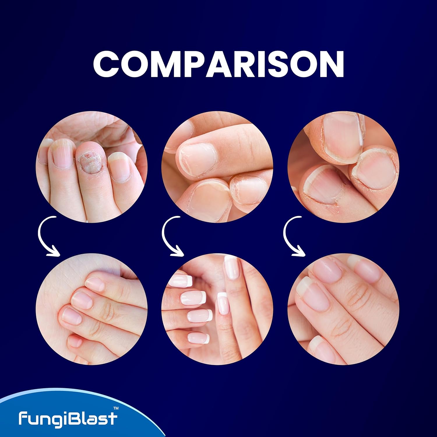 Tratamiento de hongos en las uñas de los pies, suero extra fuerte  El mejor tratamiento de crecimiento y renovación de uñas para uñas de los pies y