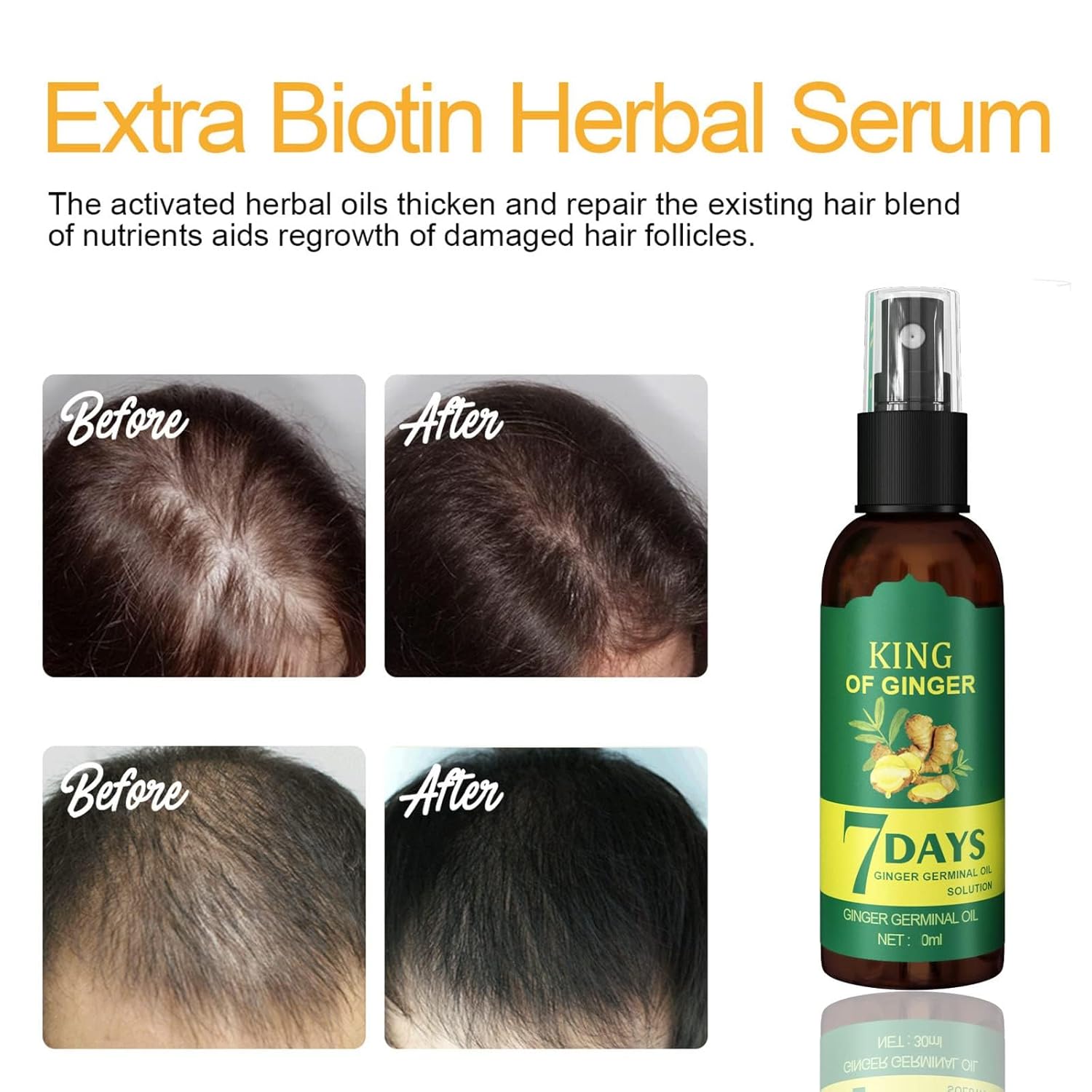 Shouga Kingu Aceite de crecimiento del cabello, aceite de jengibre para el crecimiento del cabello, aceite germinal de jengibre 7 días, King of