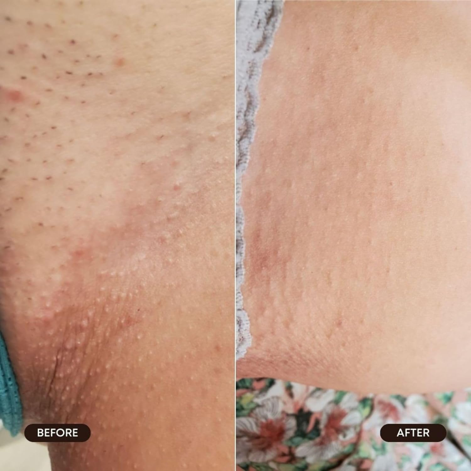 Bushbalm Roller Rescue – Suero para cabello encarnado, incluye AHA y BHA, exfoliante, calmante, refrescante para zonas íntimas, axilas, ayuda con