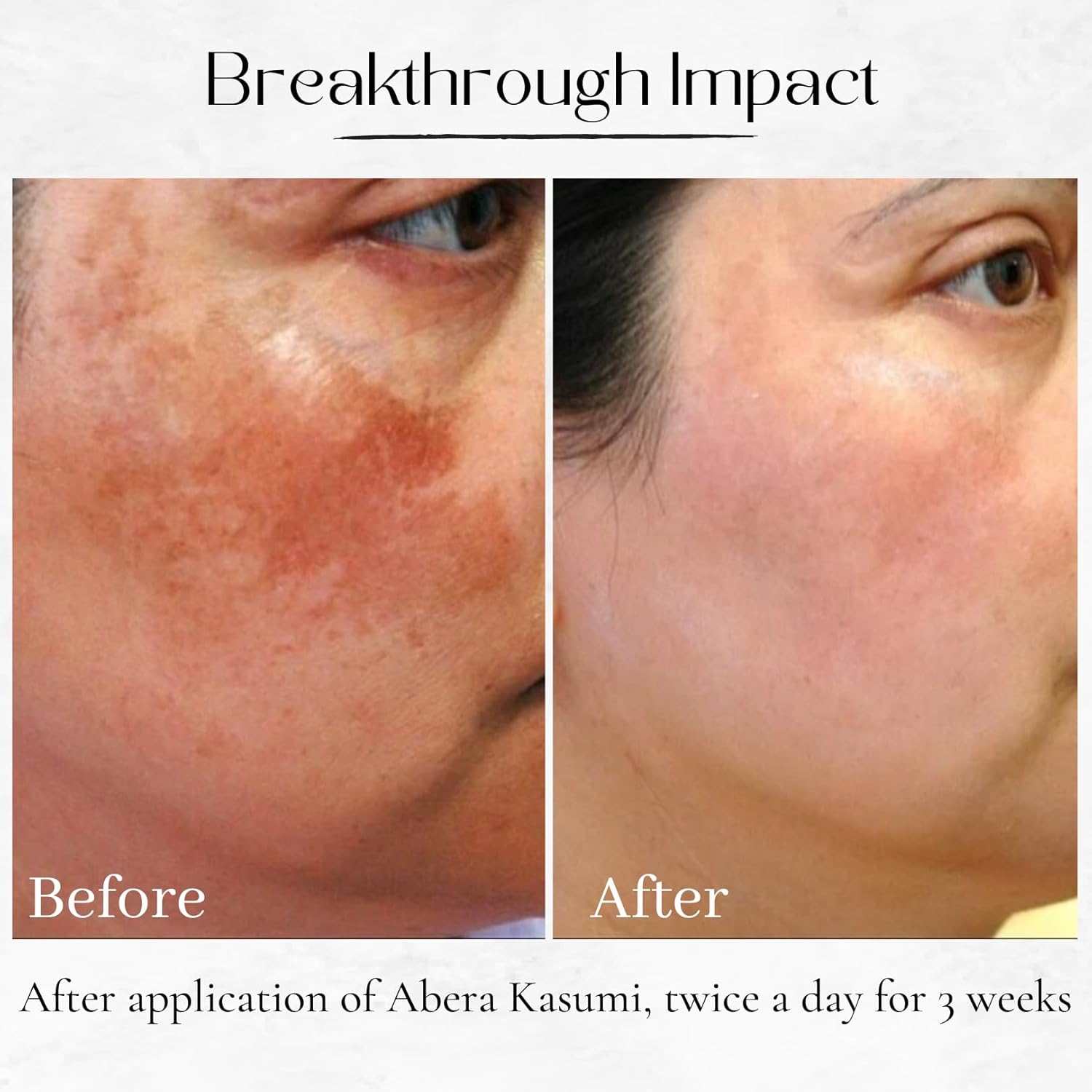 ABERA Kasumi – Crema brillante, tratamiento de melasma para cara, removedor de manchas oscuras para la cara, ilumina con parche dorado para los ojos