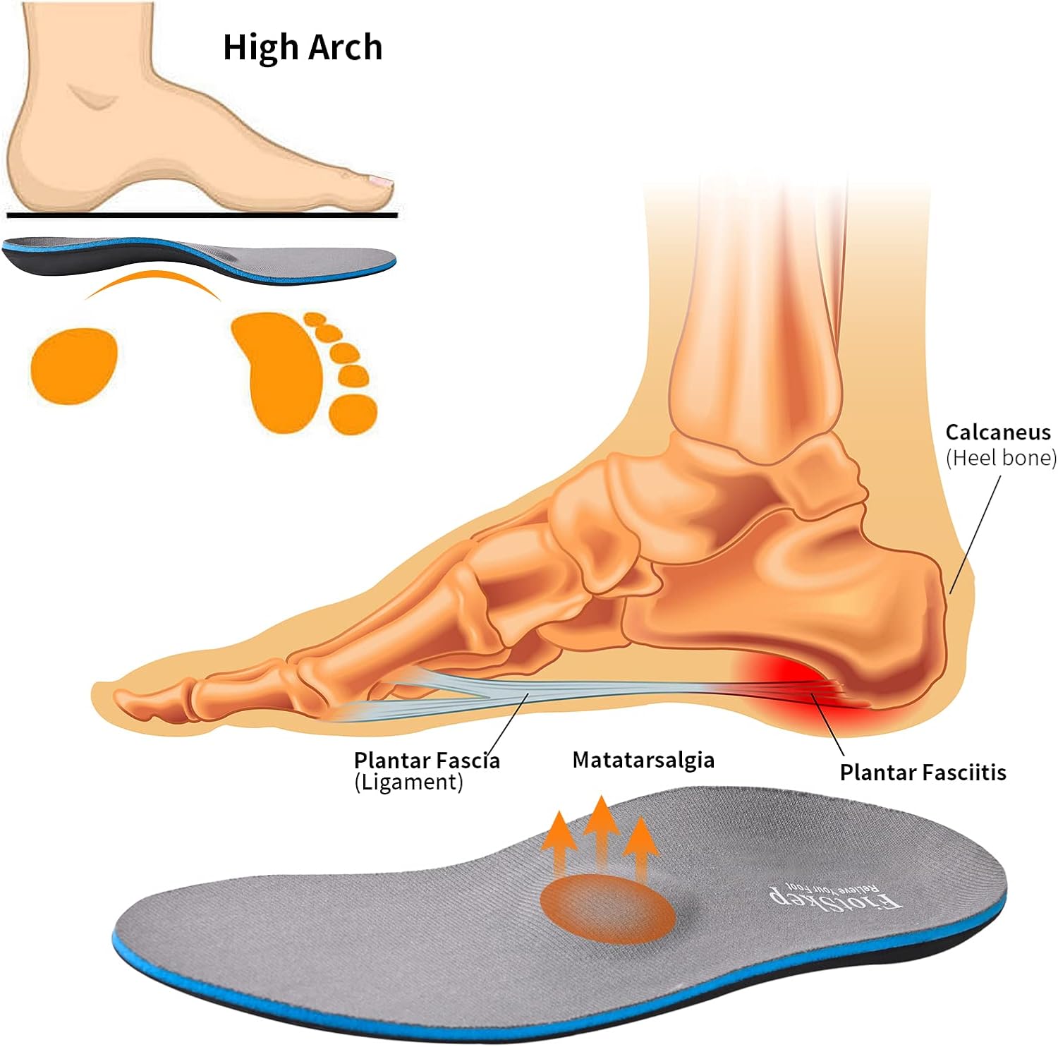 FiotSkep Almohadilla metatarsiana de arco alto para neuroma de Morton, insertos de dolor de bola de pie, fascitis plantar, pies planos, espuma