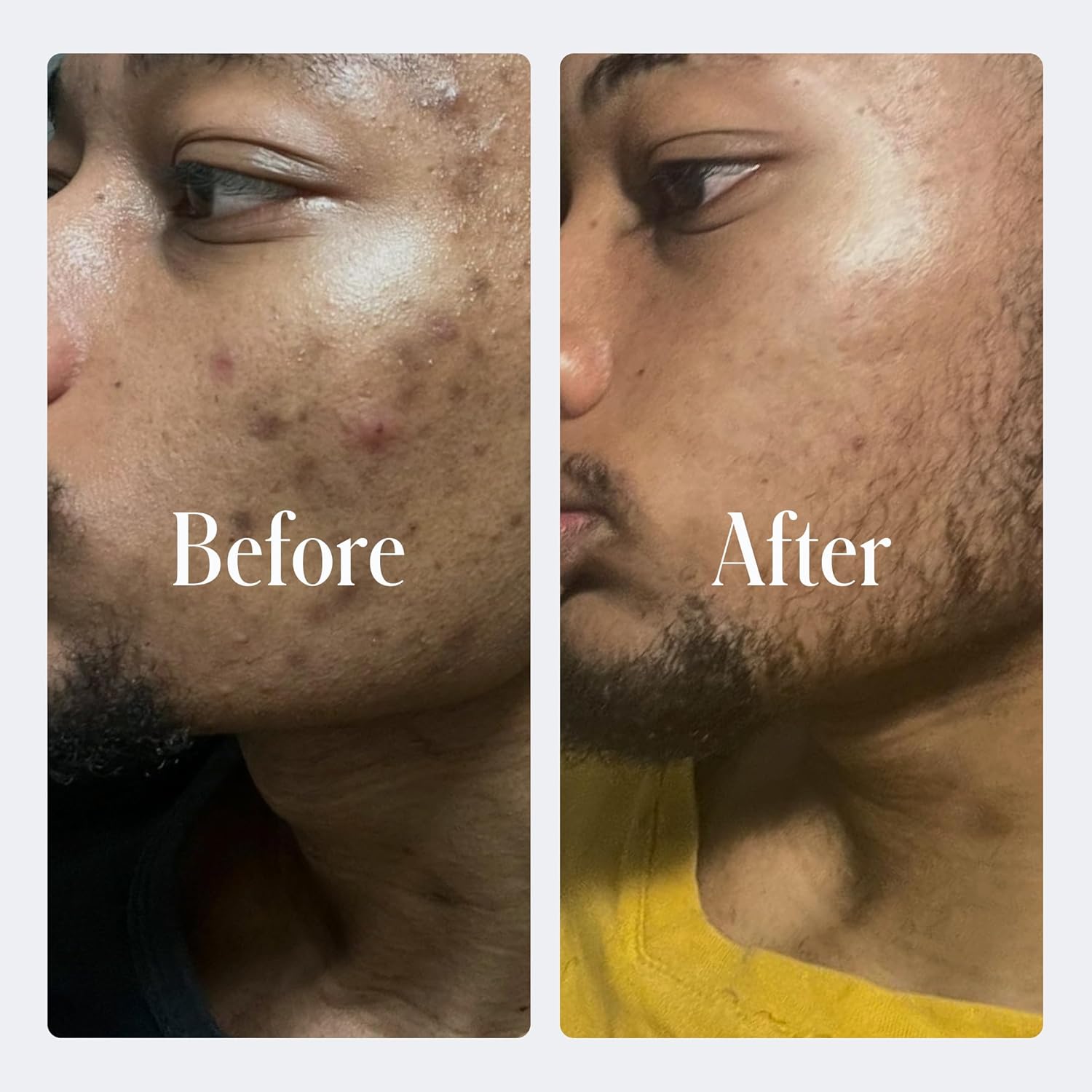 Geologie Sensitive Complete – Juego de cuidado de la piel de 5 piezas para 90 días, acné, aceite, manchas oscuras, lavado facial con ácido