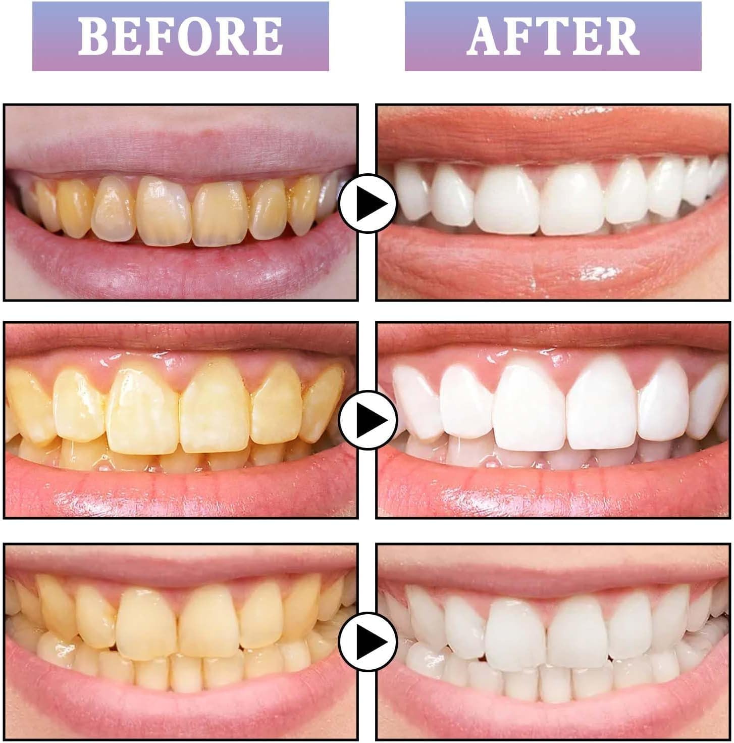 Bolígrafo blanqueador de dientes, pintura dental brillante sonriente, bolígrafo blanqueador de dientes para eliminación de manchas de dientes,