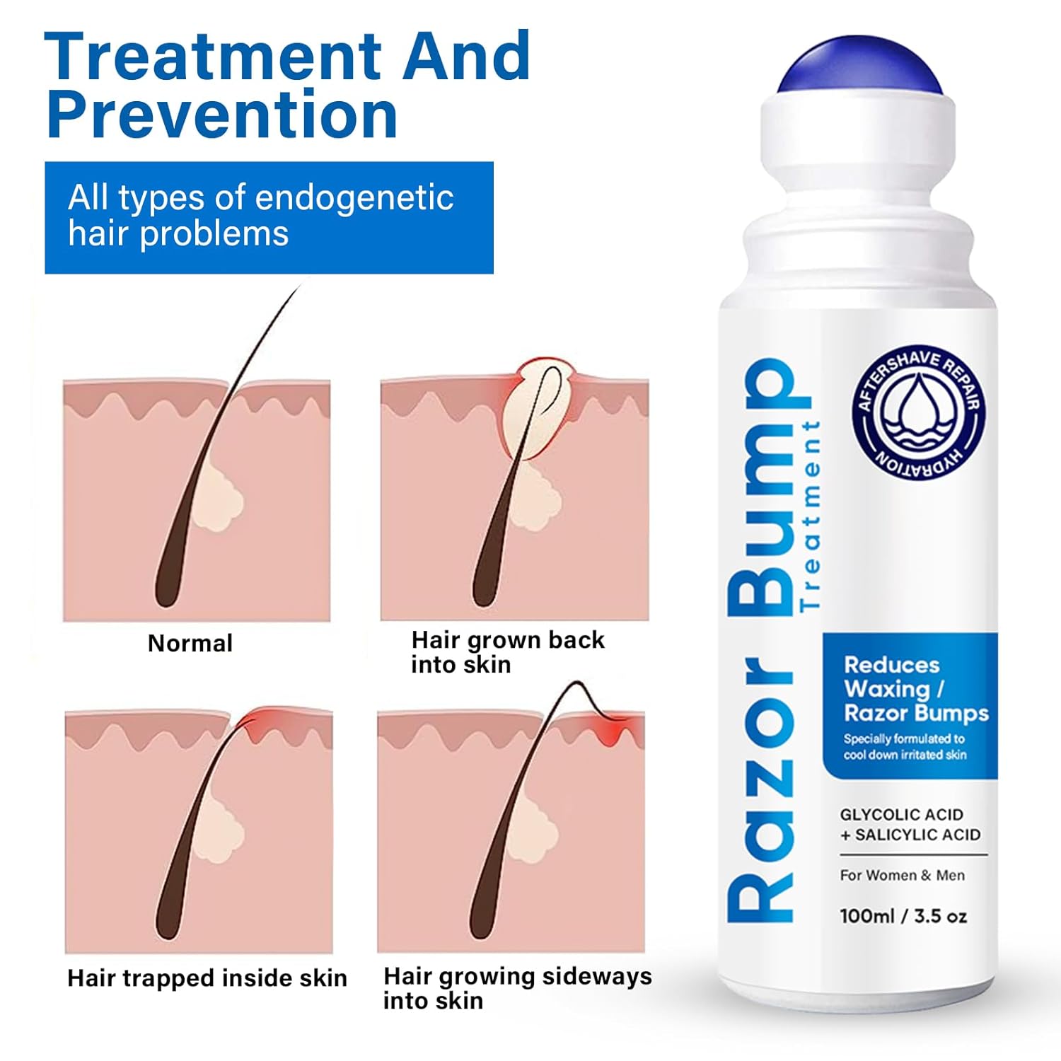 Tratamiento de golpes de afeitado para hombres y mujeres, suero para cuidado después del afeitado para encarnados y quemaduras, solución de tapón