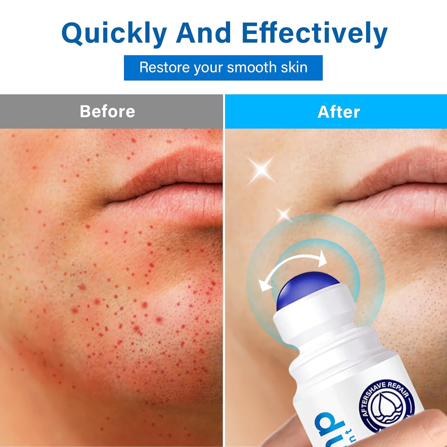 Tratamiento de golpes de afeitado para hombres y mujeres, suero para cuidado después del afeitado para encarnados y quemaduras, solución de tapón