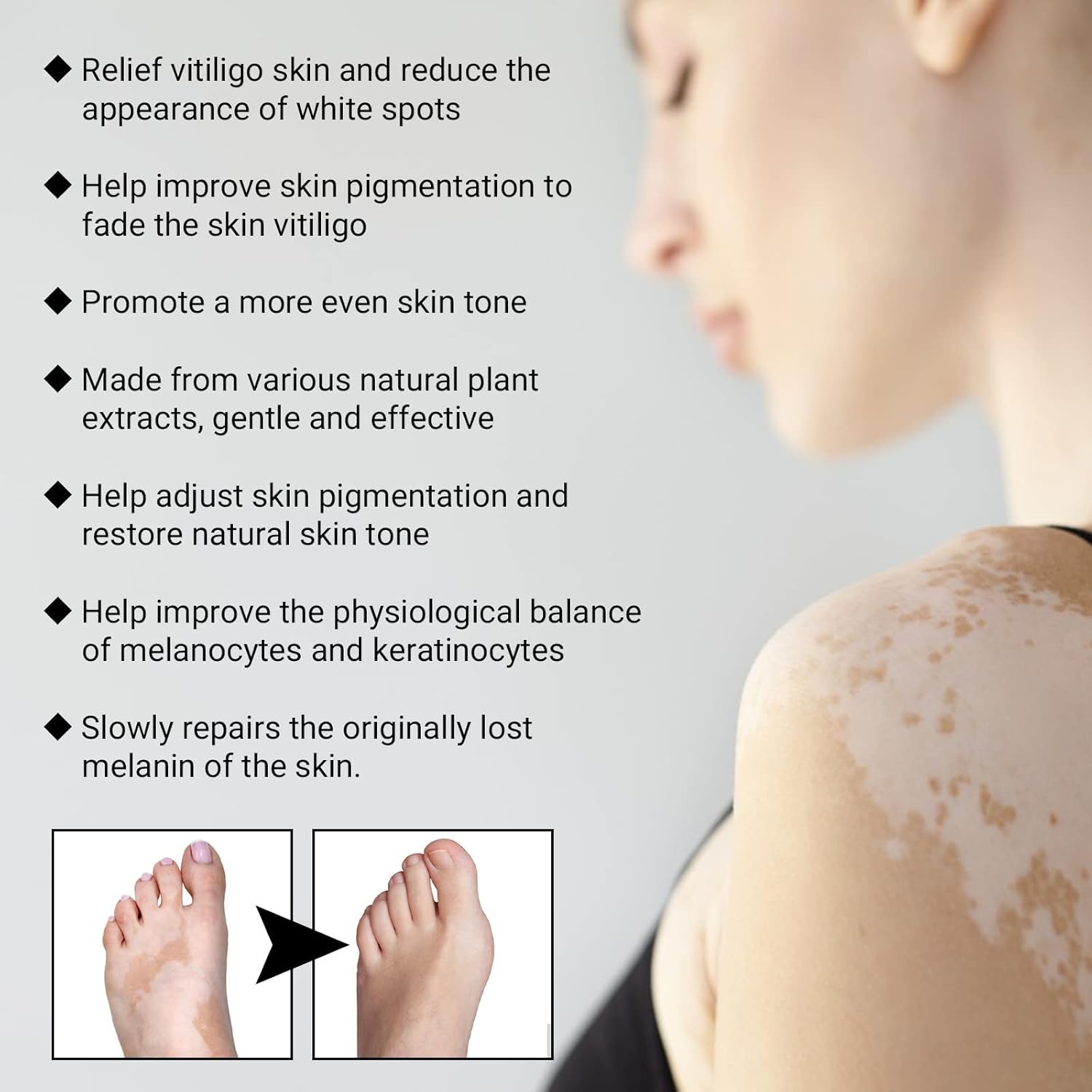 NYYQYYN EELHOE – Spray de alivio de vitiligo de manchas blancas, spray de reparación de la piel de vitiligo, spray para el cuidado de la piel,