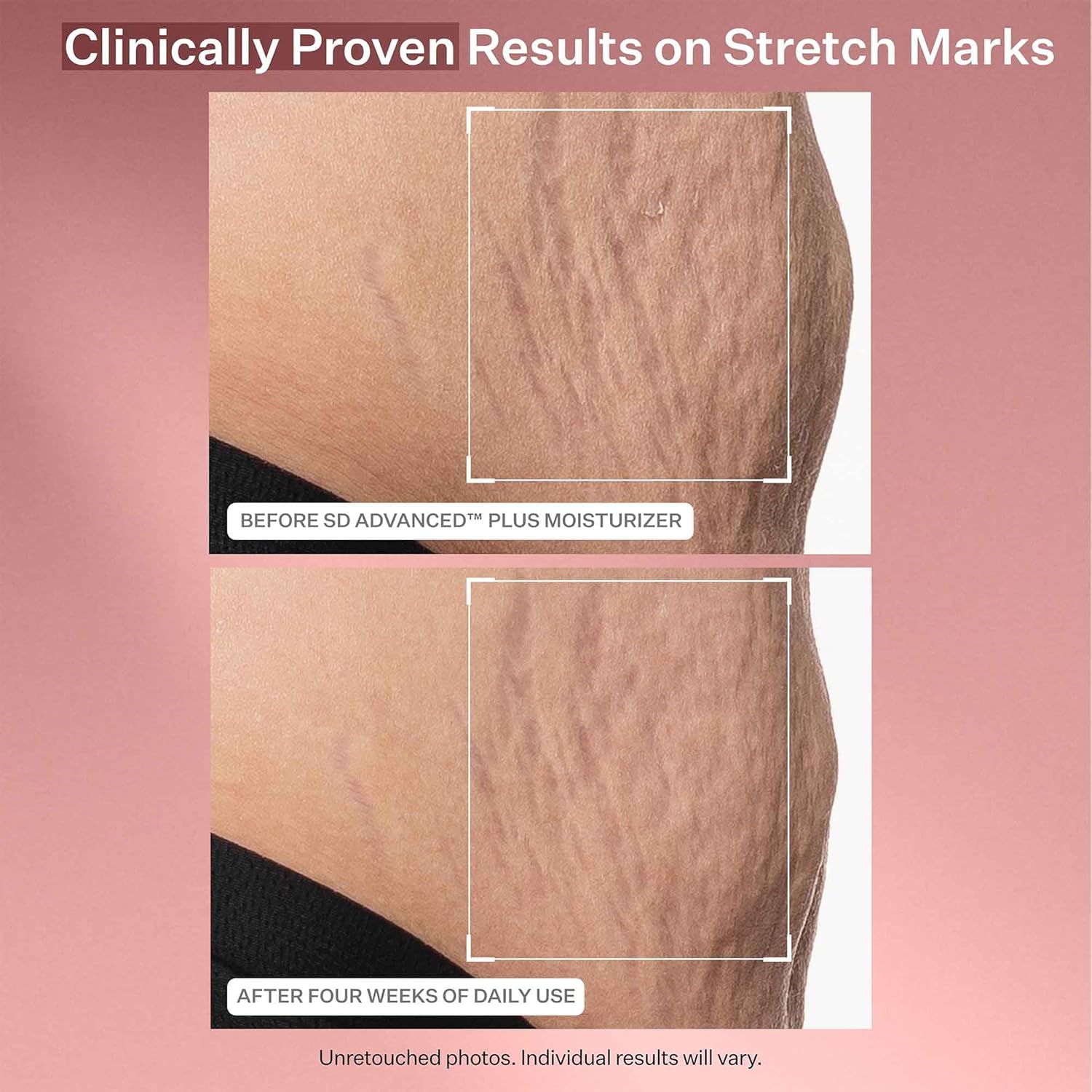StriVectin SD Advanced Plus – Hidratante intensivo para arrugas y estrías, para rostro y cuerpo, estimulante de colágeno con péptidos y ácido
