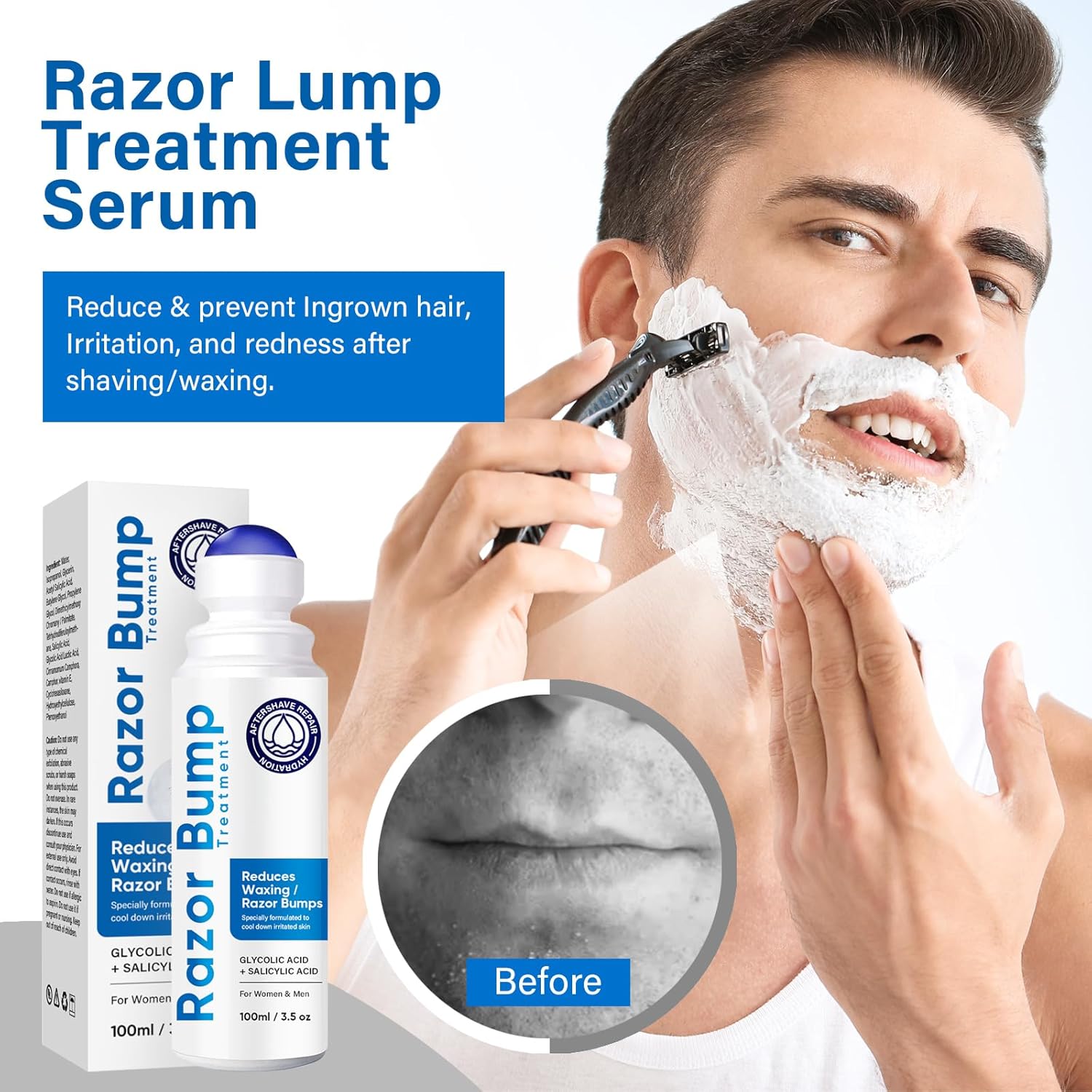 Tratamiento de golpes de afeitado para hombres y mujeres, suero para cuidado después del afeitado para encarnados y quemaduras, solución de tapón