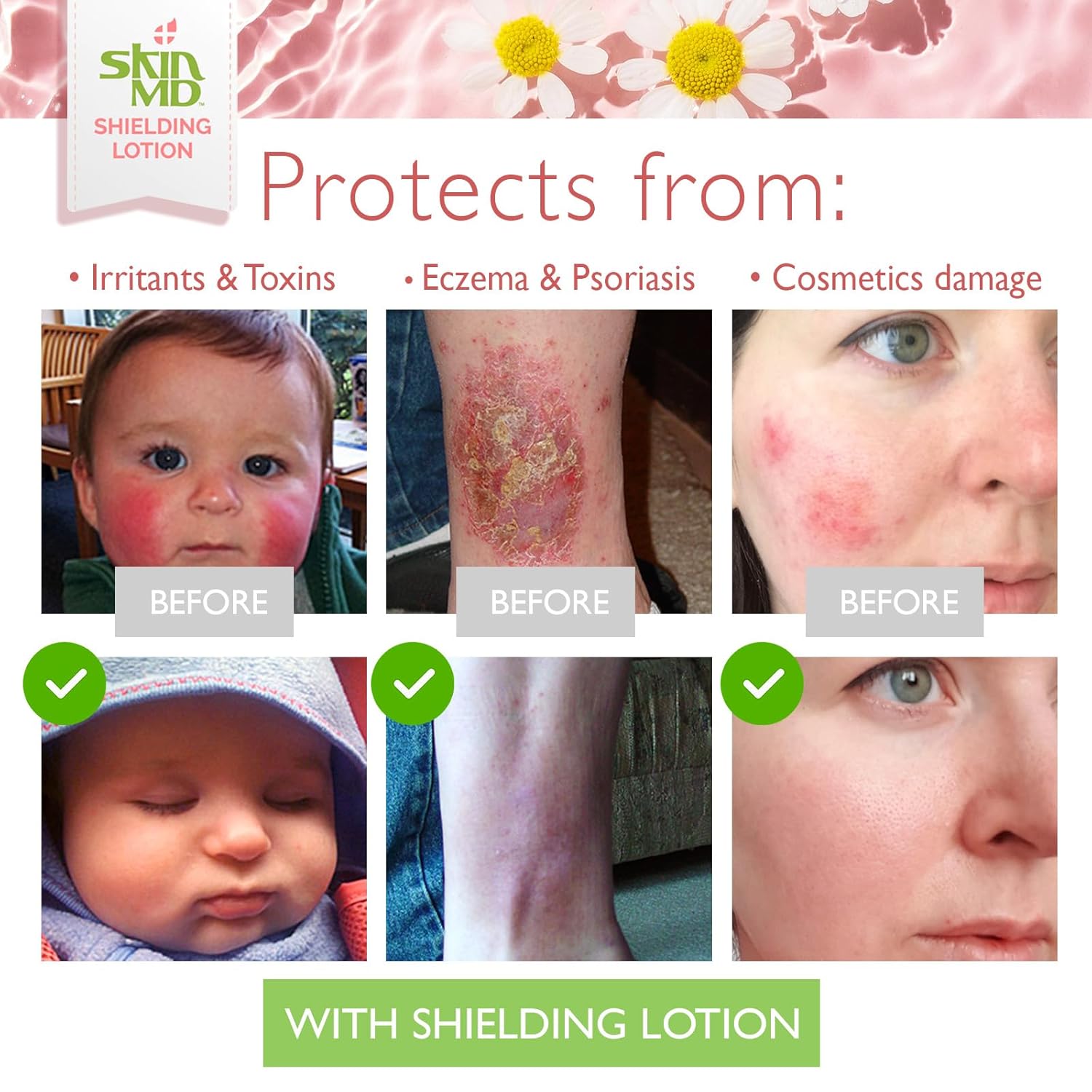 Loción protectora natural para la cara Skin MD, cuerpo y manos, ayuda con eczema y psoriasis El remedio natural a las cosas que secan tu piel
