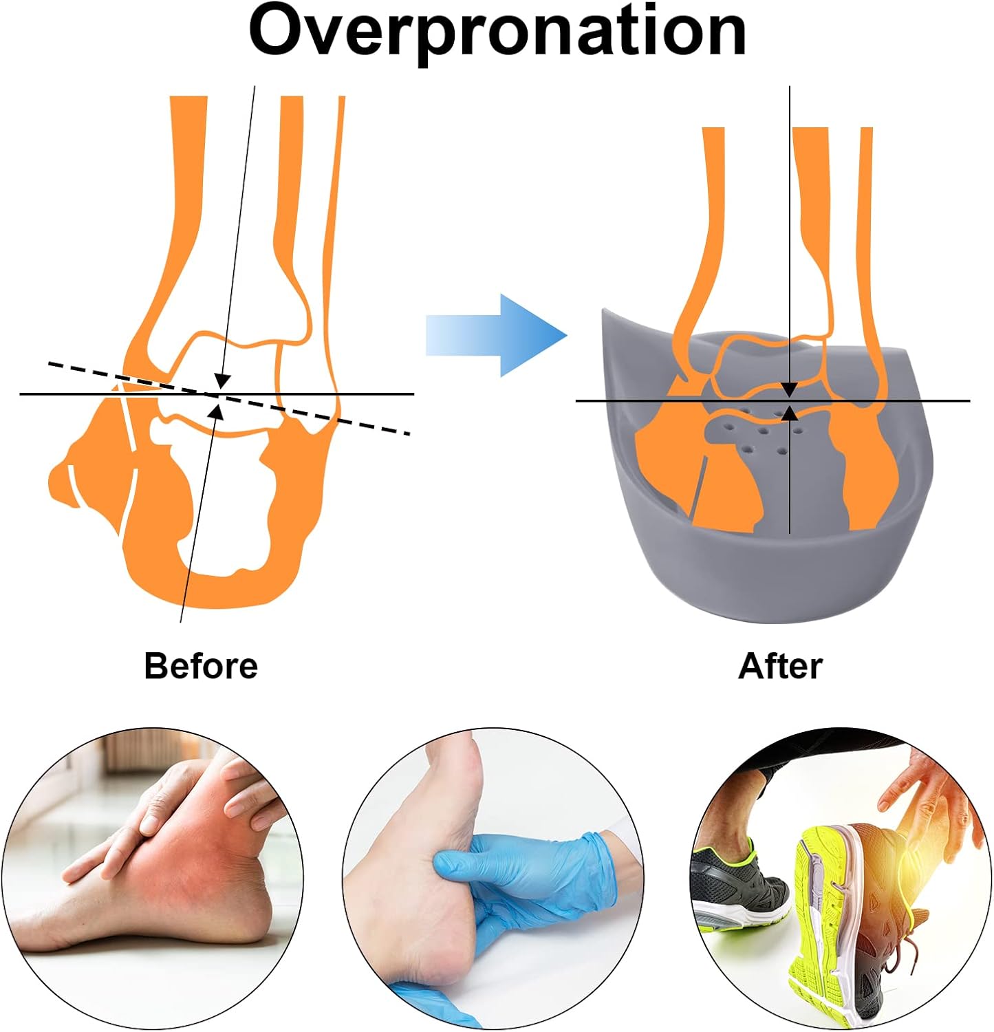 Almohadilla metatarsiana original de arco alto 34 para aliviar la pronación del pie, espalda, cadera, pierna y rodilla, espolones para el dolor para