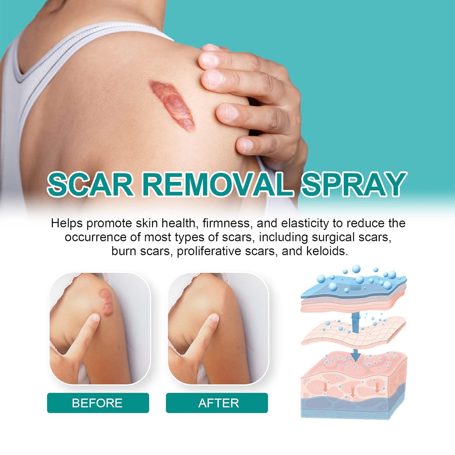 South Moon – Spray de cicatrices de grado médico, Scarremove Advanced Cicatrices Spray, spray médico para eliminar cicatrices, spray de cicatrices