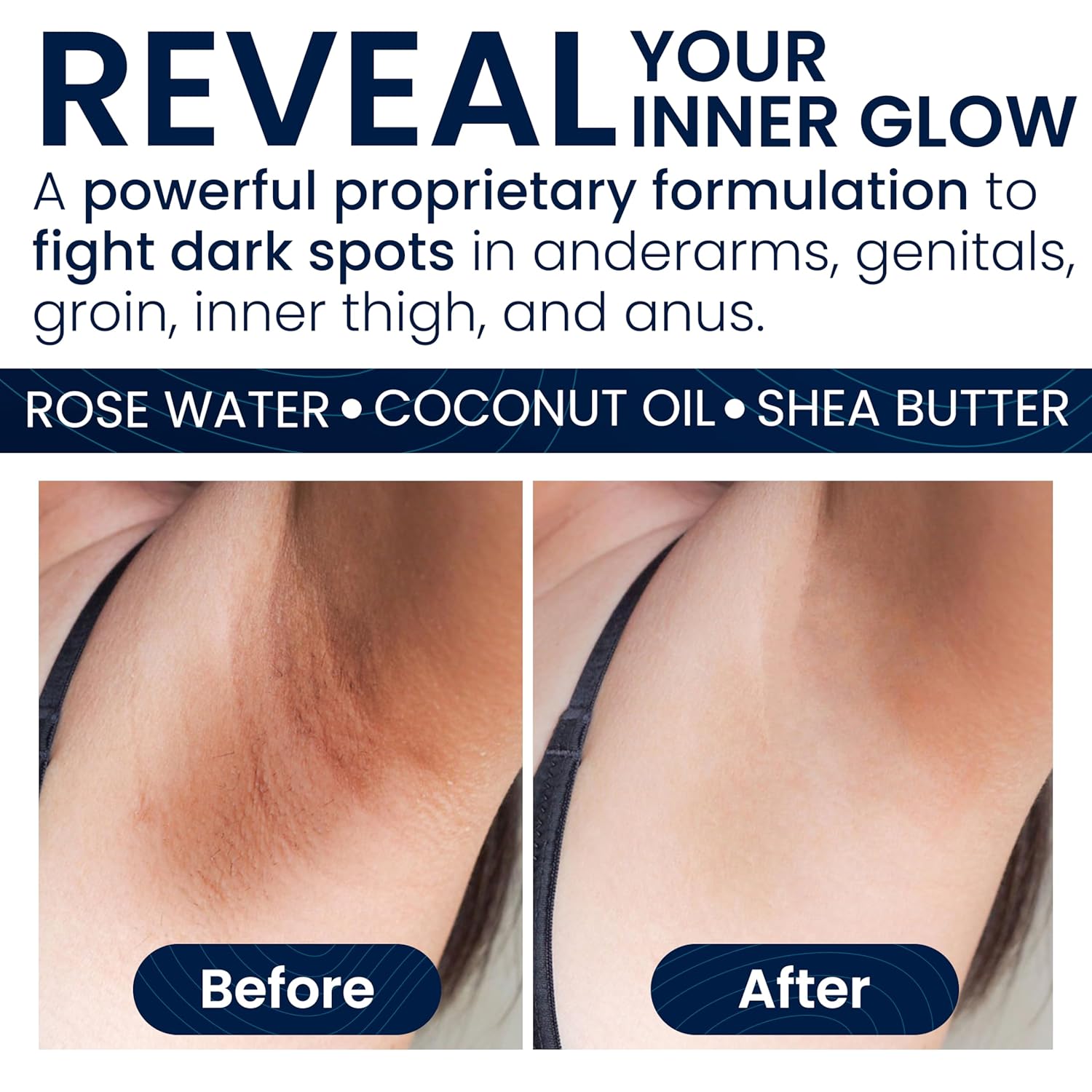 Crema eliminadora de manchas oscuras para áreas íntimas  Muslo interior, axilas, codos, rodillas, áreas y líneas del bikini  wglicerina, ácido