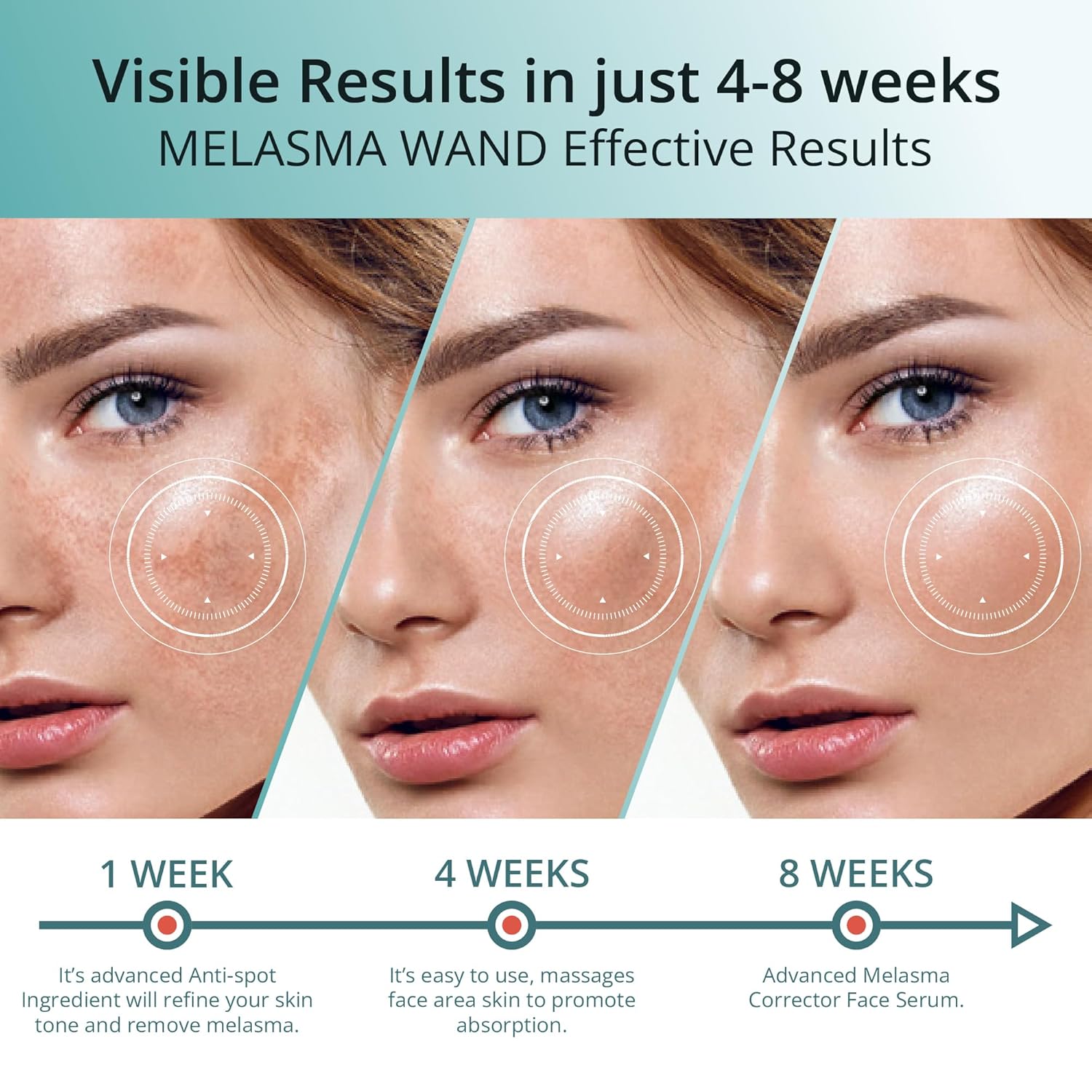 Abera Tratamiento de melasma para cara, removedor de manchas oscuras de melasma, suero corrector de manchas oscuras con juego de 5 máscaras para