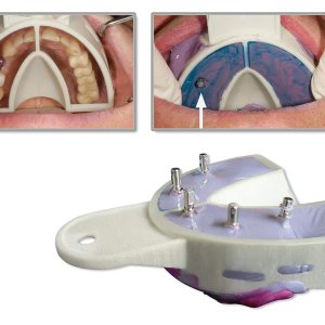 HWW Miratray Implant Advaned Lower I1 (pequeño) Set de 6 HWW Miratray Implant Advaned Lower I1 (pequeño) Set de 6