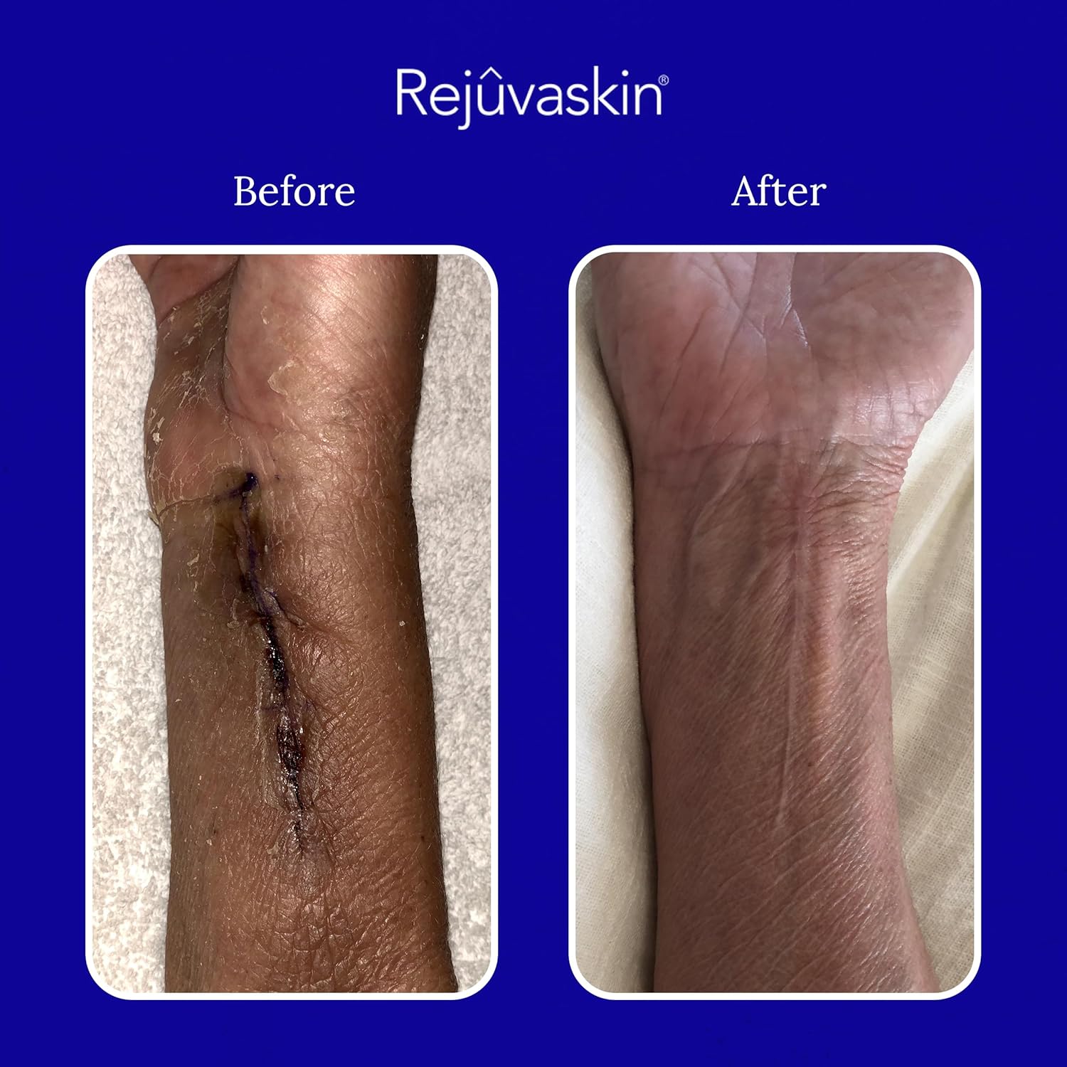 Rejuvaskin Kit de curación de cicatrices para cicatrices pequeñas, suavizar, aplanar, reducir y recuperar, láminas de silicona, gel RejuvaSil y