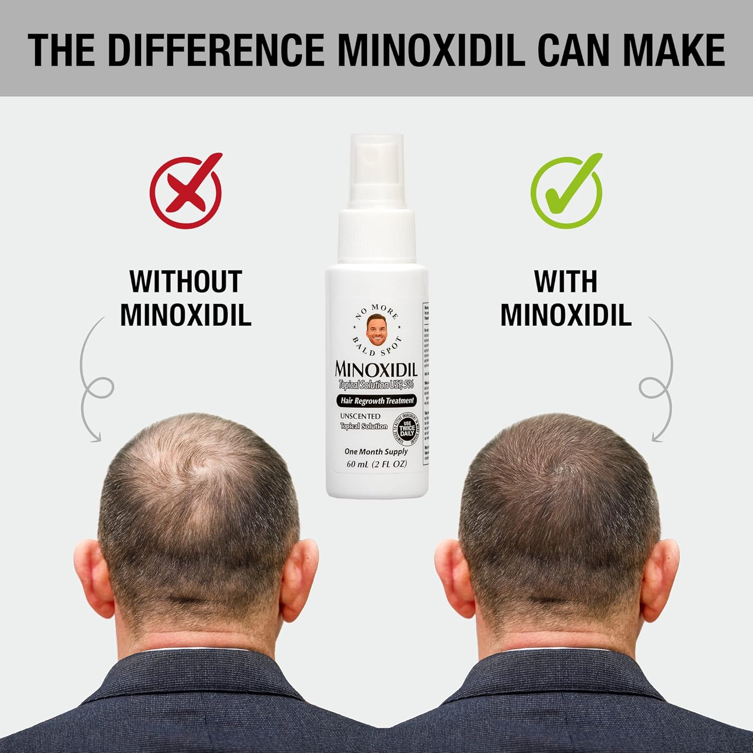No More Bald Spot 5% de minoxidil para hombres – Tratamiento de crecimiento del cabello para mujeres – Tratamiento de pérdida de cabello – Solución