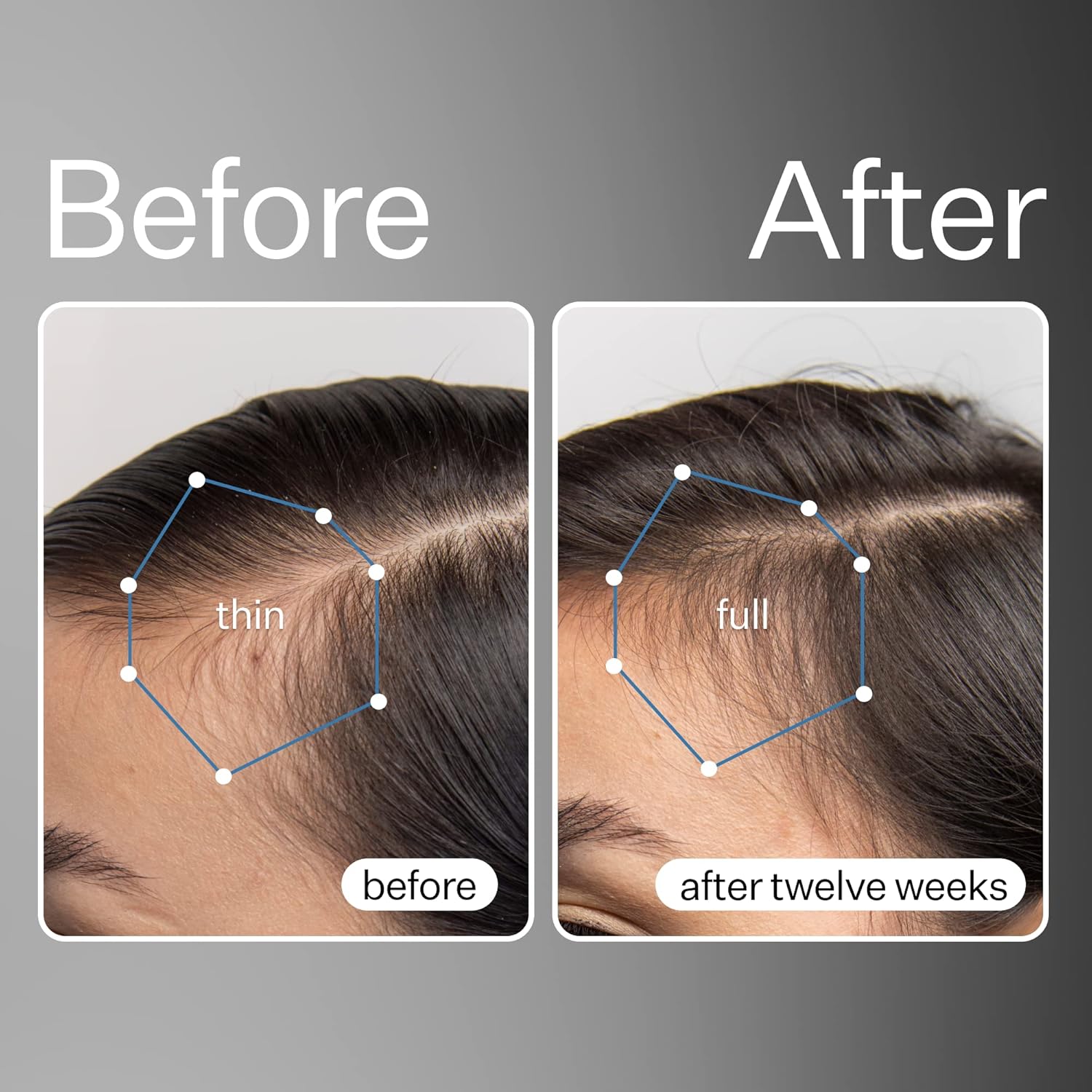 Act+Acre – Suero de células madre procesadas en frío y cápsulas de cabello grueso y completo, promueve un cabello más grueso y de aspecto más
