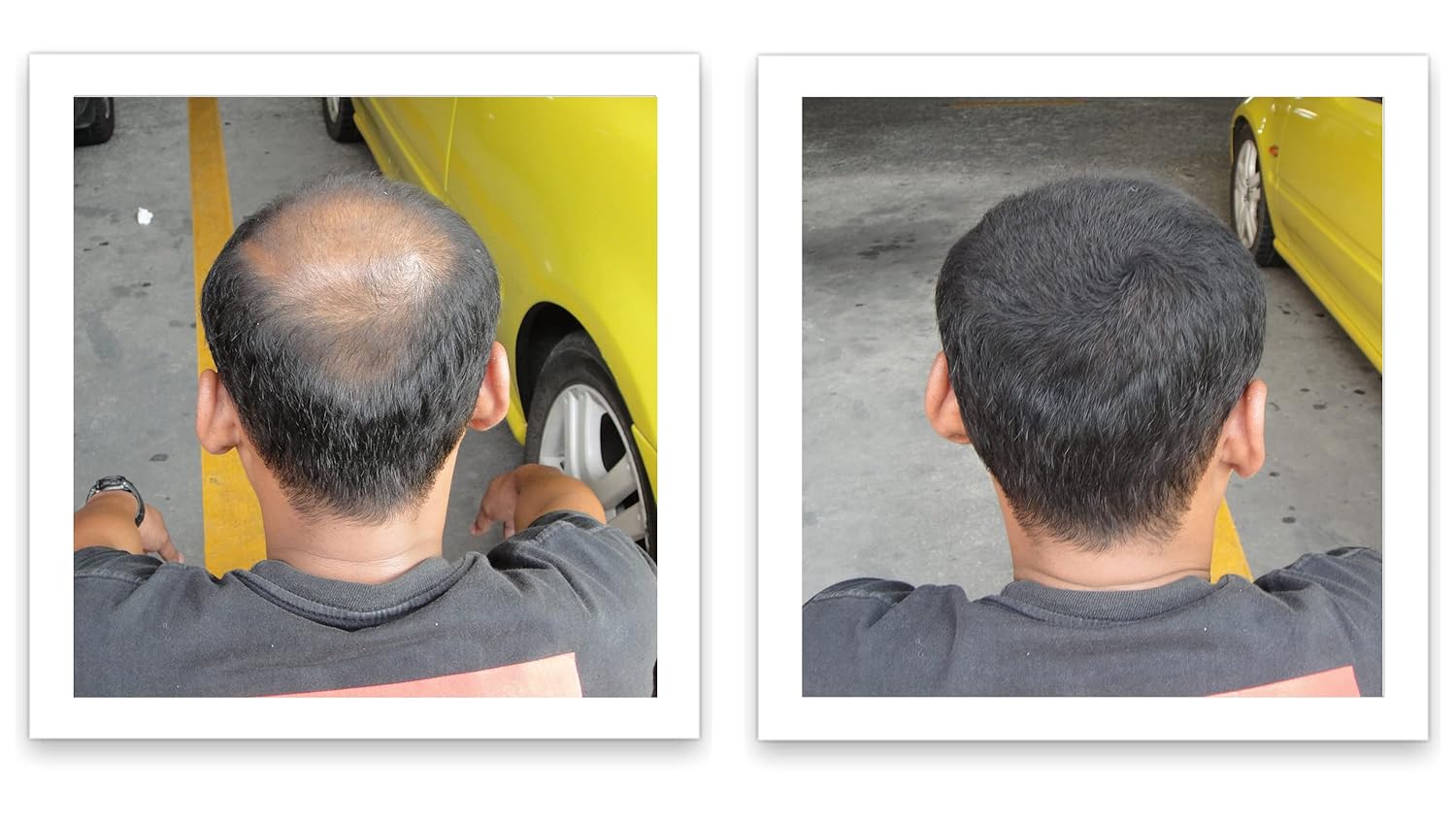 Oculta puntos calvos y bordes calvos al instante. Haz que el cabello fino se vea 10 veces más lleno. Kit de inicio de fibra capilar Caboki (negro)
