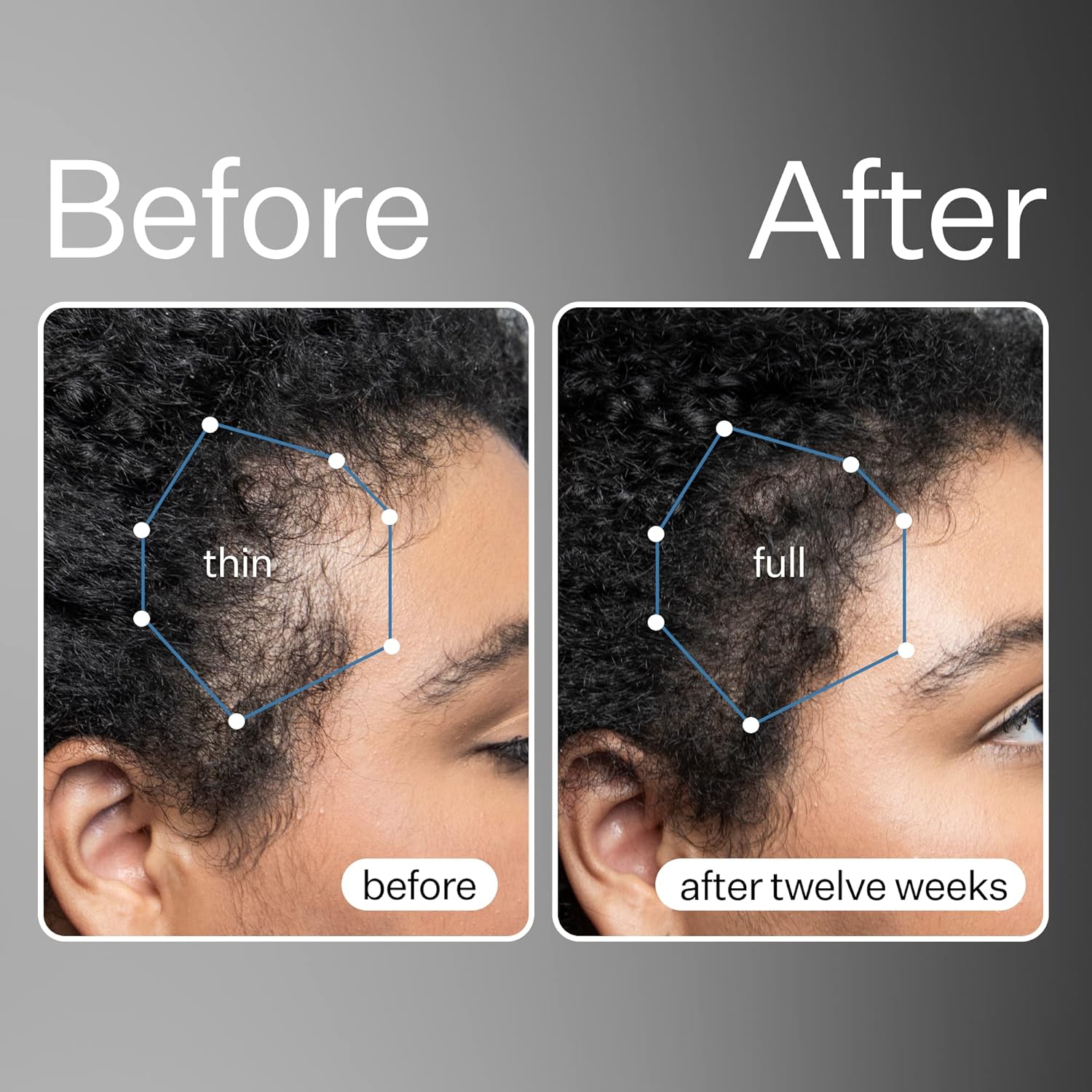 Act+Acre – Suero de células madre procesadas en frío y cápsulas de cabello grueso y completo, promueve un cabello más grueso y de aspecto más