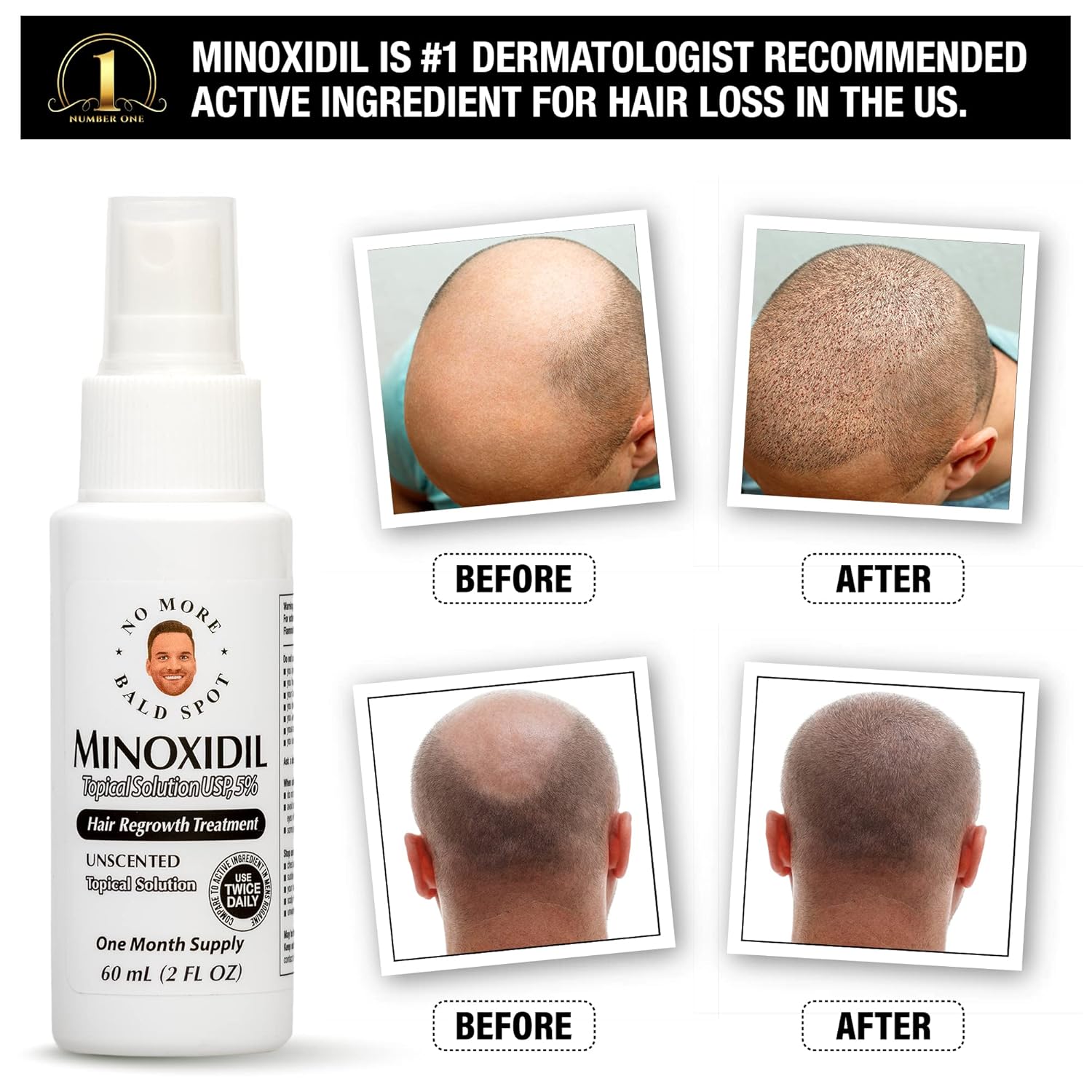 No More Bald Spot 5% de minoxidil para hombres – Tratamiento de crecimiento del cabello para mujeres – Tratamiento de pérdida de cabello – Solución