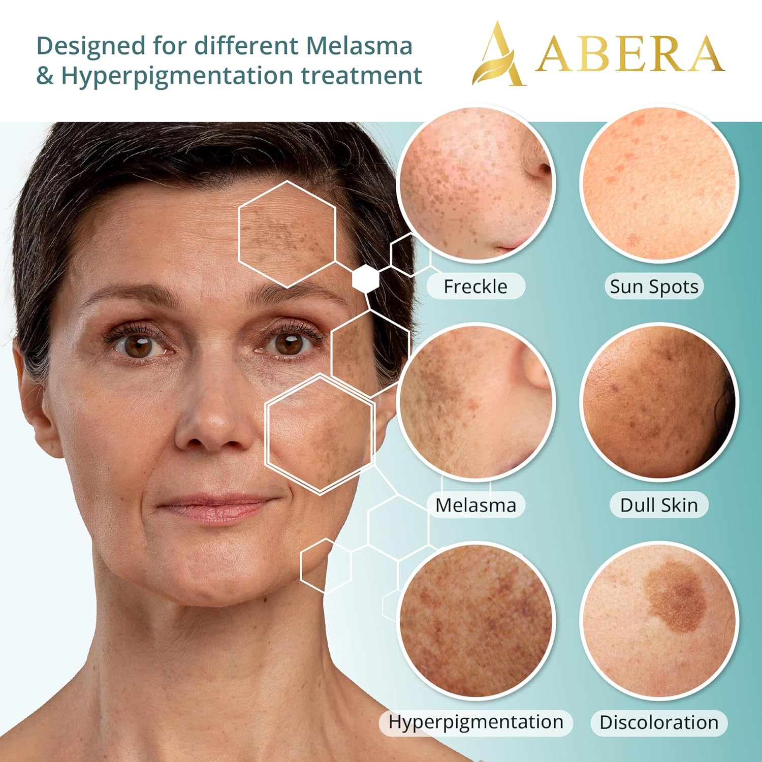 Abera Tratamiento de melasma para cara, removedor de manchas oscuras de melasma, suero corrector de manchas oscuras con juego de 5 máscaras para