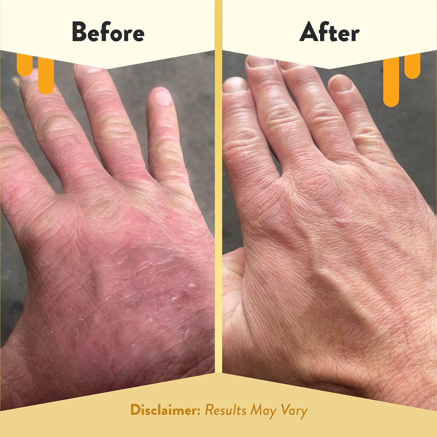 ECZEMA HONEY Jabón de manos suave espumoso  Limpiador suave para manos secas  Jabón de manos no tóxico sin perfume  Limpiador de manos natural para