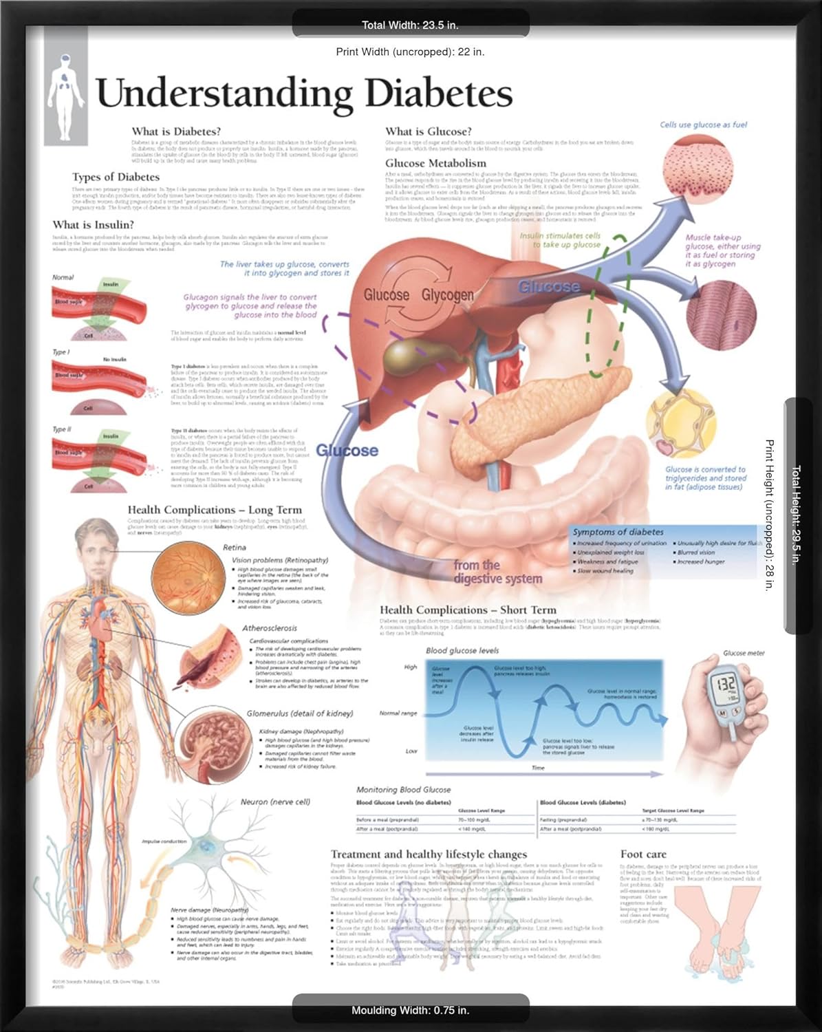 AllPosters Póster de pared para entender la diabetes, gráfico educativo sobre marco negro, 22 x 28 pulgadas