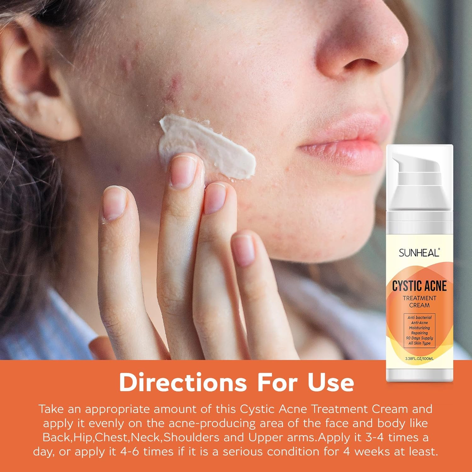 Tratamiento de acné quístico – Crema para el acné para adolescentes y adultos, tratamiento del acné con ingredientes especiales contra el acné
