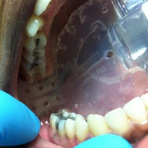 Adaptador de reducción de aerosoles dentales para ISOLITEDRYSHIELD + 4 piezas de boca Adaptador de reducción de aerosoles dentales para ISOLITEDRYSHIELD + 4 piezas de boca